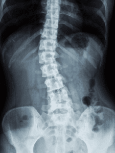 lesiones medula espinal